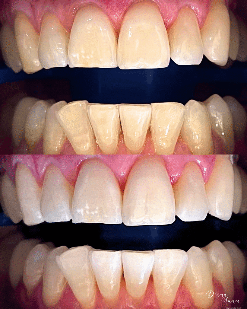 Illustration of teeth whitening with a brighter smile